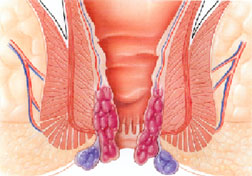 肛窦炎引发的原因及其治疗方法